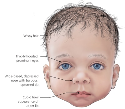 Noonan Syndrome Gene Review
